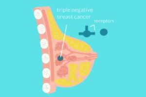 triple-negative breast cancer