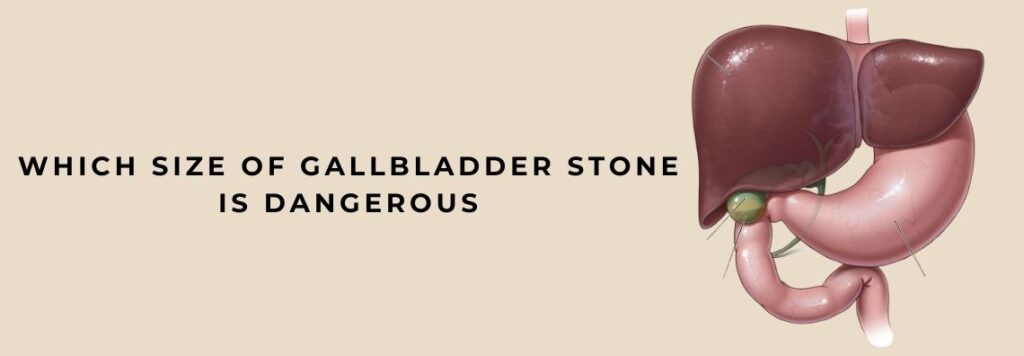 Which Size of Gallbladder Stone is Dangerous
