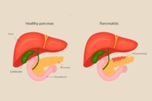 Pancreas Problems