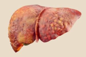 Fatty Liver Disease