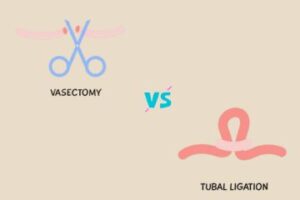 Vasectomy vs. tubal ligation