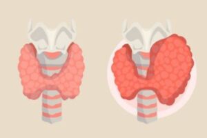 thyroid level